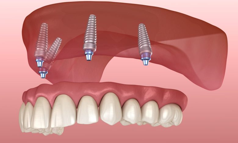 dentures near me