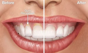 Gum Recession