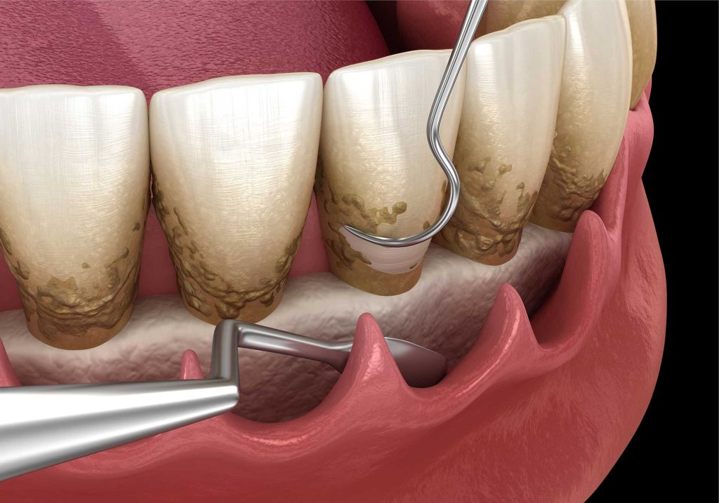 dental deep cleaning cost