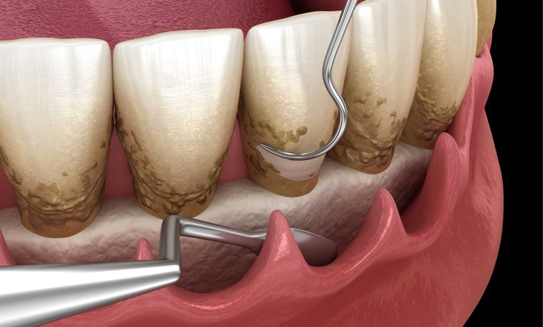 dental deep cleaning cost